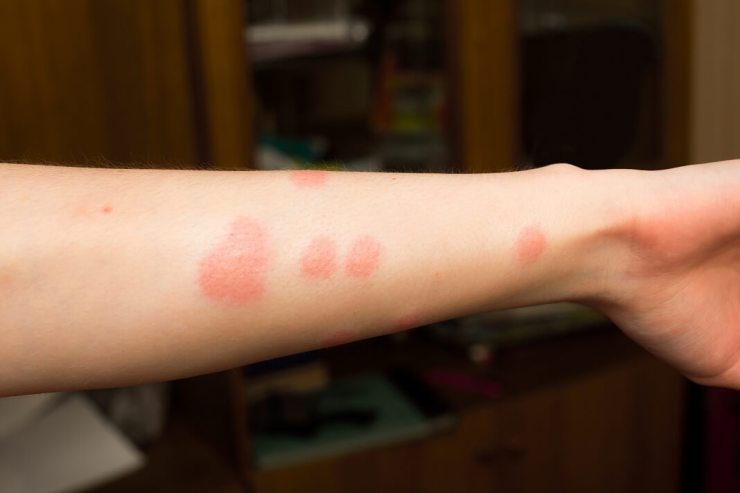 Beneficial Natural and Alternative Remedies to Cure Flea Bites